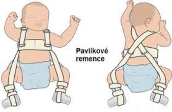 PROTETIKA Pavlikove remence č.2 (1-4mesiacov)